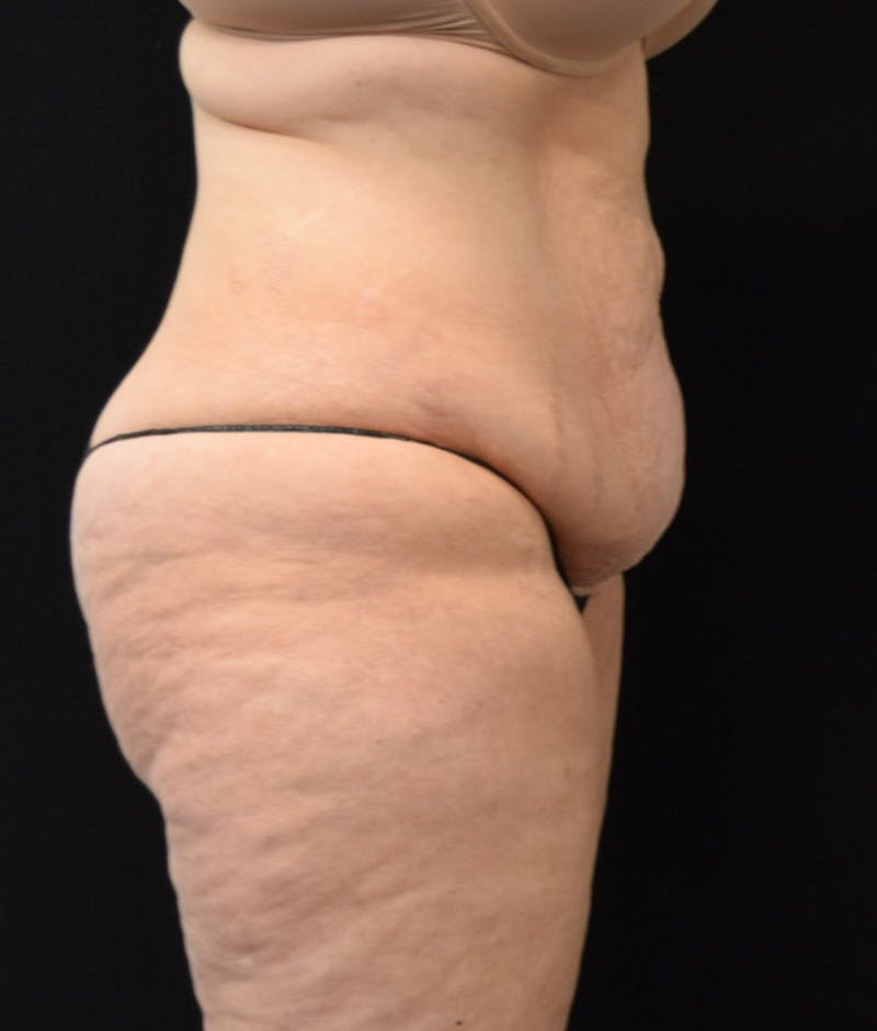 Lower Body Lift Before & After Gallery - Patient 142681560 - Image 5