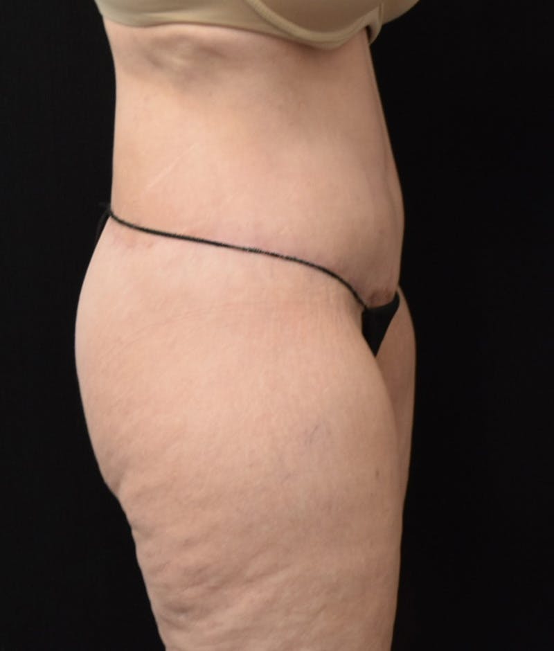 Lower Body Lift Before & After Gallery - Patient 142681560 - Image 6