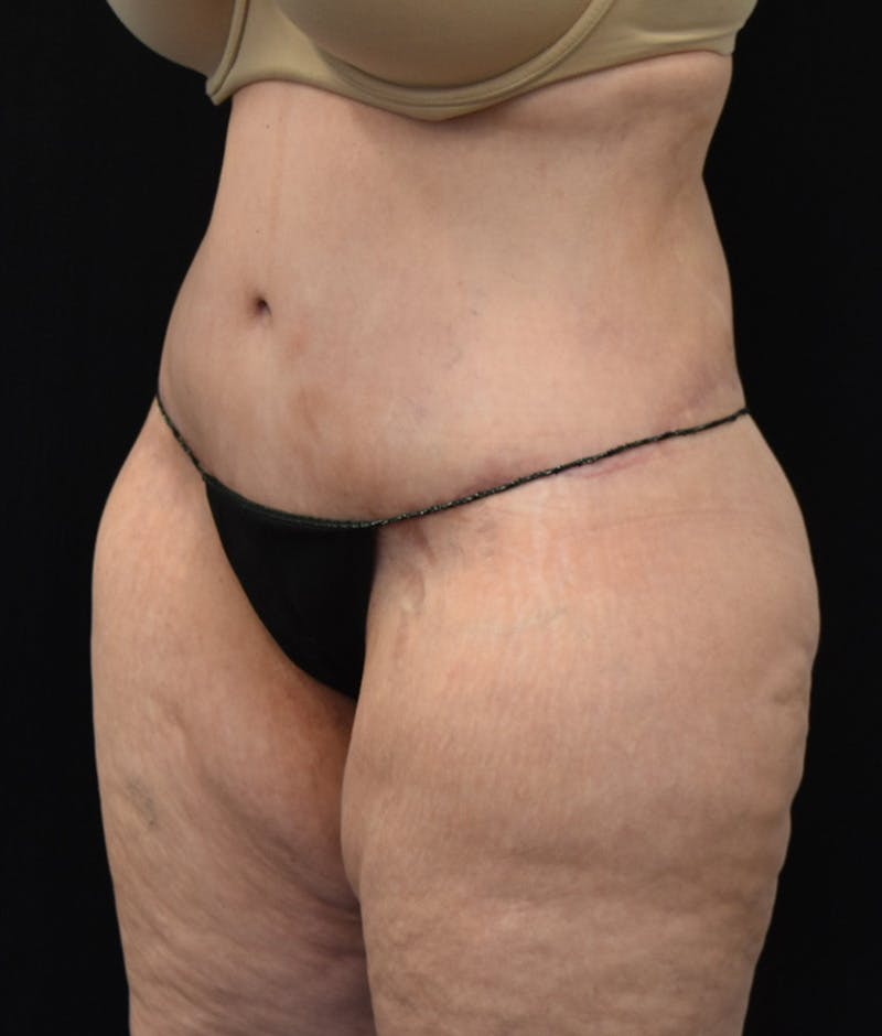 Lower Body Lift Before & After Gallery - Patient 142681560 - Image 8