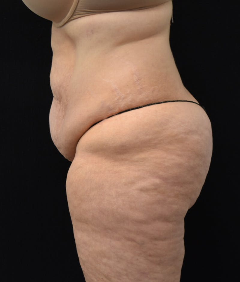 Lower Body Lift Before & After Gallery - Patient 142681560 - Image 9
