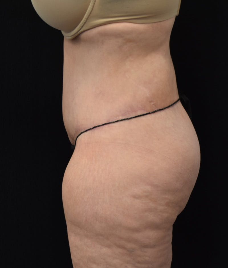 Lower Body Lift Before & After Gallery - Patient 142681560 - Image 10