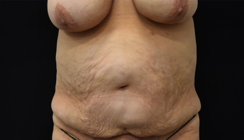 Abdominoplasty Before & After Gallery - Patient 142899458 - Image 1