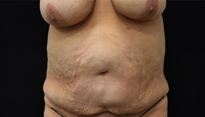 Abdominoplasty Before & After Gallery - Patient 142899458 - Image 1