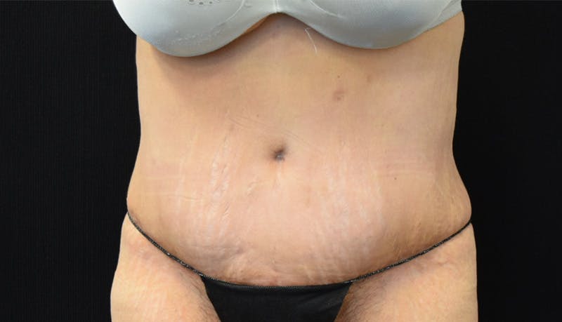 Abdominoplasty Before & After Gallery - Patient 142899458 - Image 2