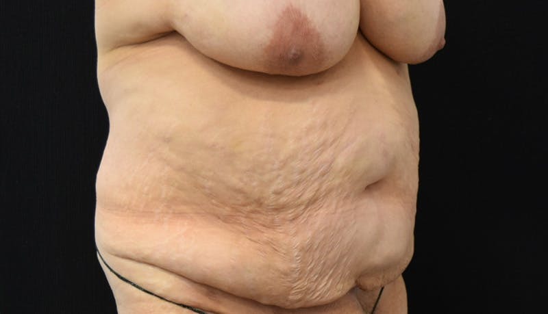 Abdominoplasty Before & After Gallery - Patient 142899458 - Image 3