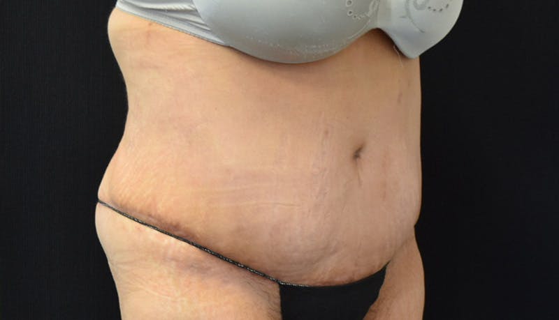 Abdominoplasty Before & After Gallery - Patient 142899458 - Image 4