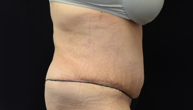 Abdominoplasty Before & After Gallery - Patient 142899458 - Image 6