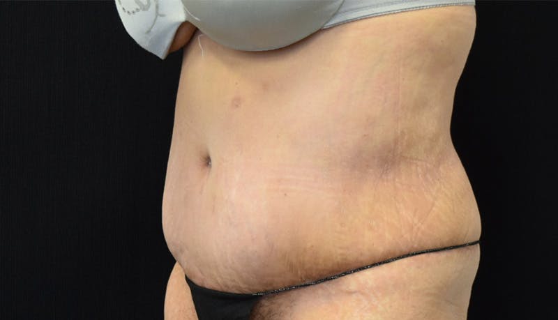 Abdominoplasty Before & After Gallery - Patient 142899458 - Image 8