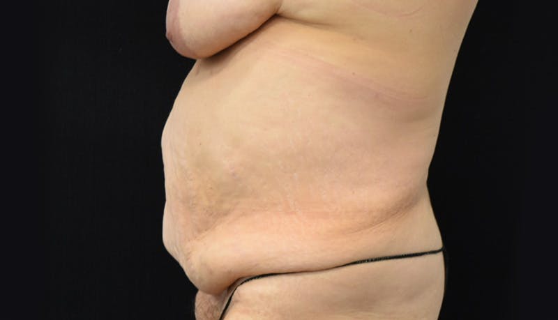Abdominoplasty Before & After Gallery - Patient 142899458 - Image 9