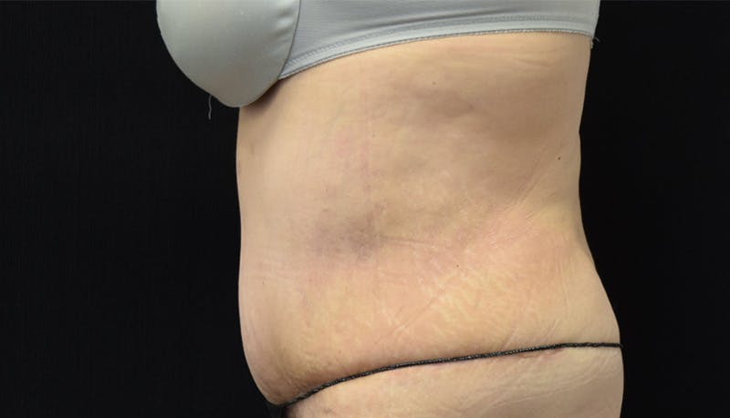 Abdominoplasty Before & After Gallery - Patient 142899458 - Image 10