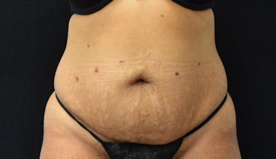 Abdominoplasty Before & After Gallery - Patient 142926008 - Image 1