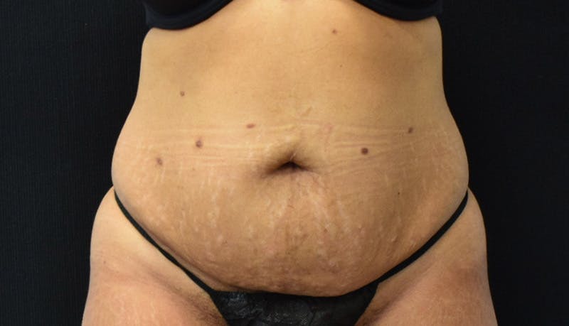 Abdominoplasty Before & After Gallery - Patient 142926008 - Image 1