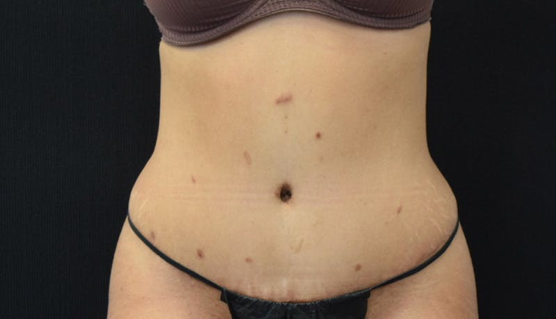 Abdominoplasty Before & After Gallery - Patient 142926008 - Image 2