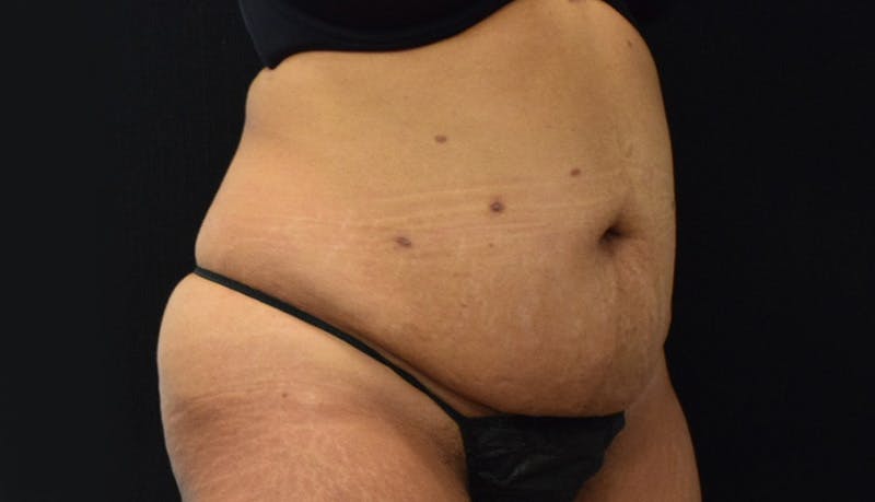 Abdominoplasty Before & After Gallery - Patient 142926008 - Image 3