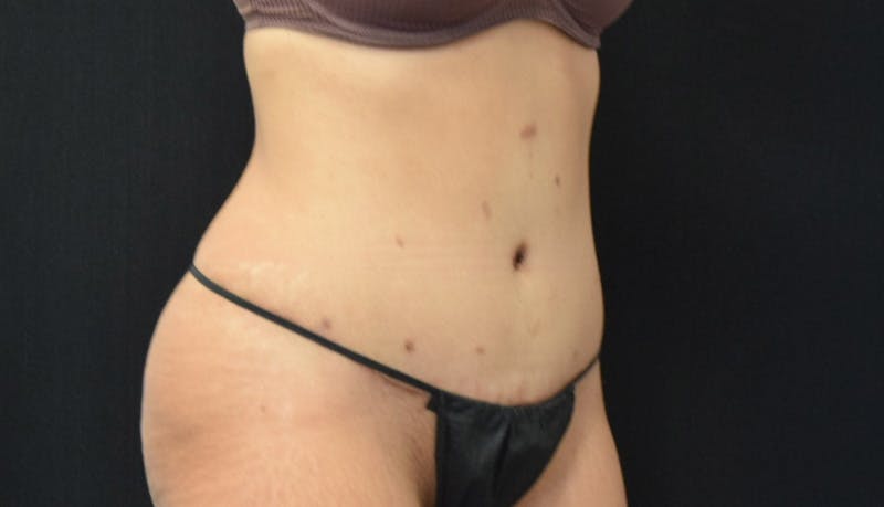 Abdominoplasty Before & After Gallery - Patient 142926008 - Image 4