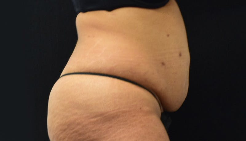 Abdominoplasty Before & After Gallery - Patient 142926008 - Image 5