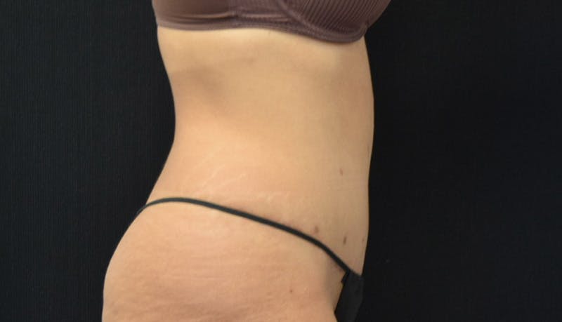 Abdominoplasty Before & After Gallery - Patient 142926008 - Image 6