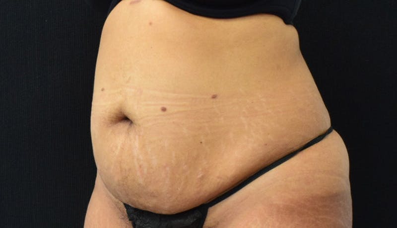 Abdominoplasty Before & After Gallery - Patient 142926008 - Image 7