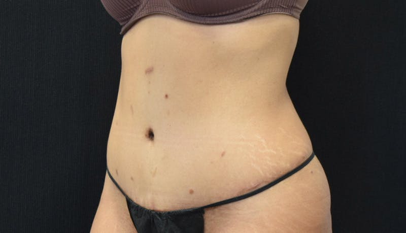 Abdominoplasty Before & After Gallery - Patient 142926008 - Image 8