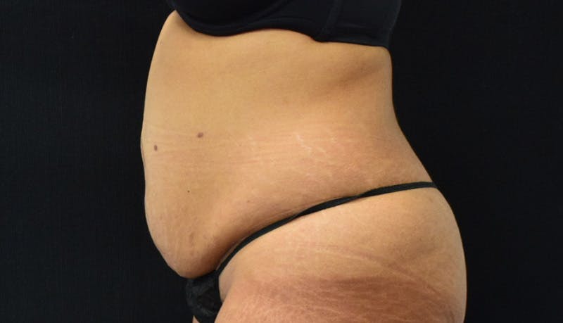 Abdominoplasty Before & After Gallery - Patient 142926008 - Image 9