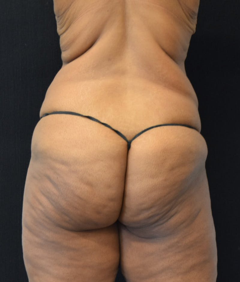 Lower Body Lift Before & After Gallery - Patient 143441943 - Image 11