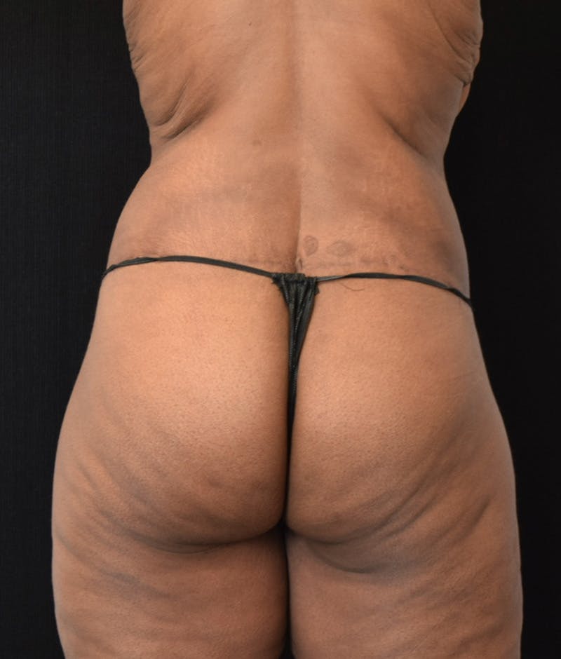 Lower Body Lift Before & After Gallery - Patient 143441943 - Image 12