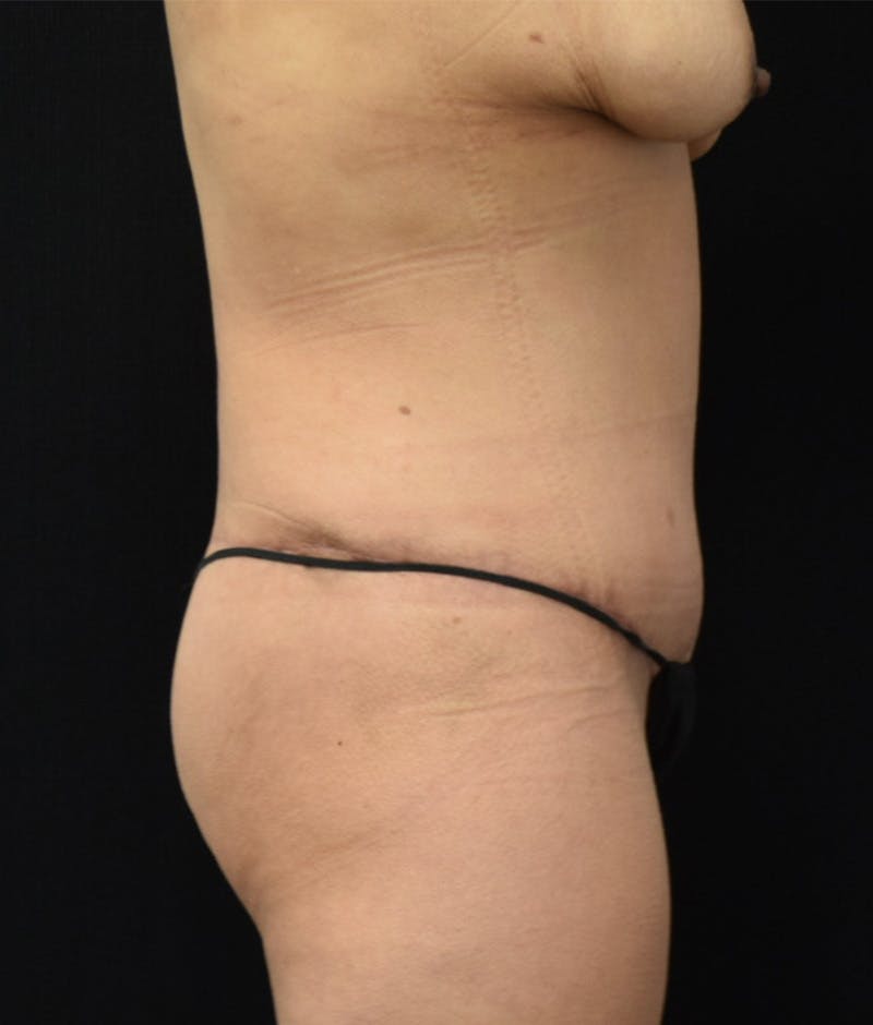Lower Body Lift Before & After Gallery - Patient 143441979 - Image 4