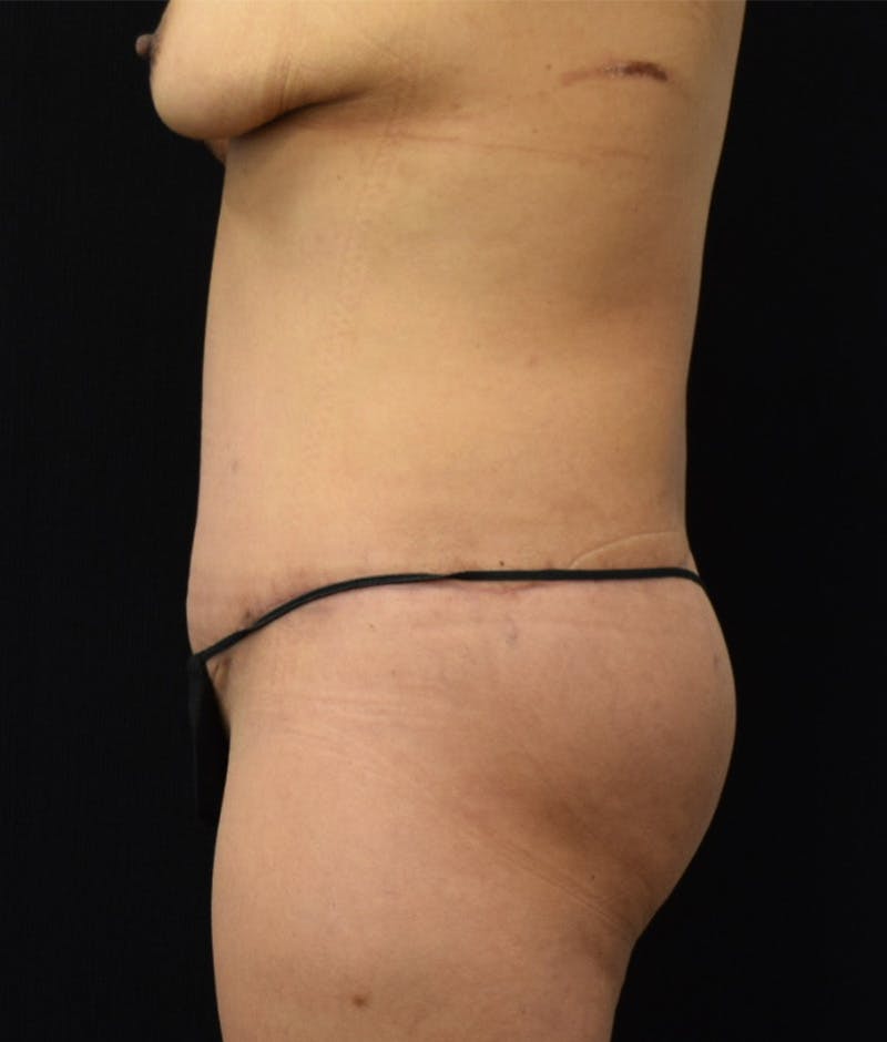 Lower Body Lift Before & After Gallery - Patient 143441979 - Image 8