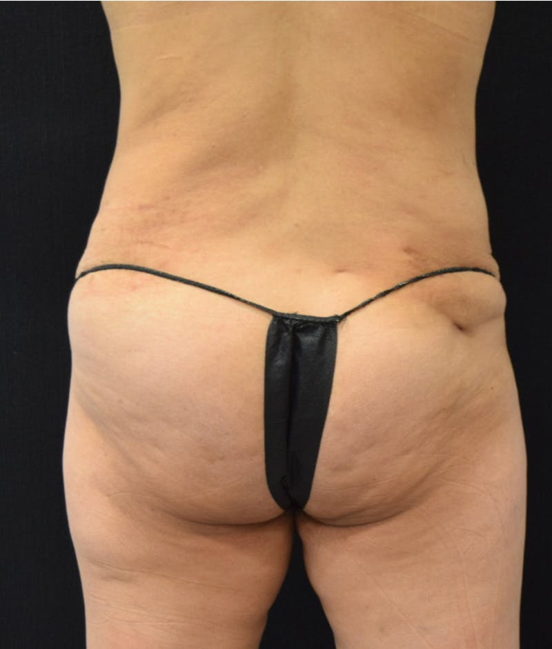Lower Body Lift Before & After Gallery - Patient 143441979 - Image 9