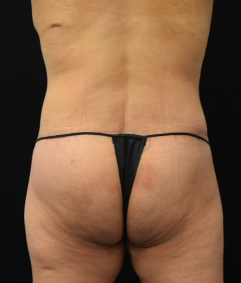 Lower Body Lift Before & After Gallery - Patient 143441979 - Image 10