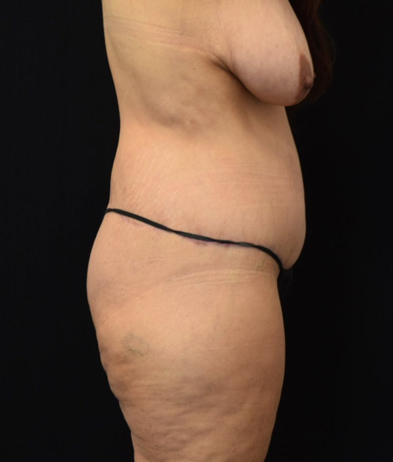 Lower Body Lift Before & After Gallery - Patient 144174571 - Image 6