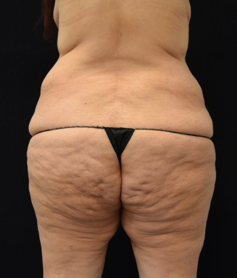Lower Body Lift Before & After Gallery - Patient 144174571 - Image 7
