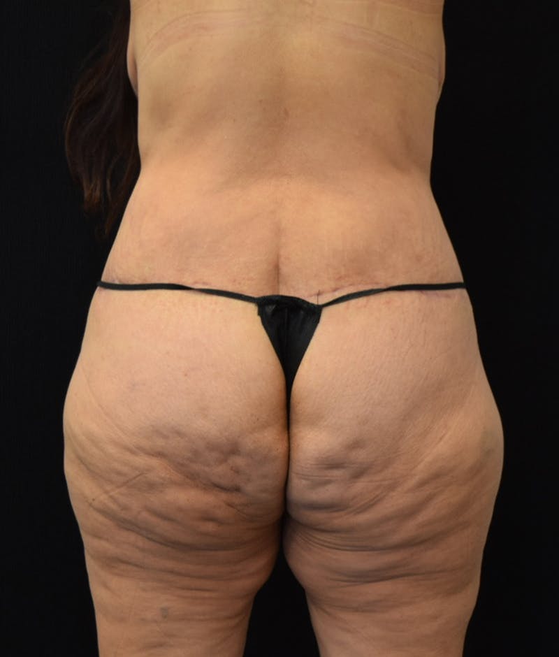 Lower Body Lift Before & After Gallery - Patient 144174571 - Image 8