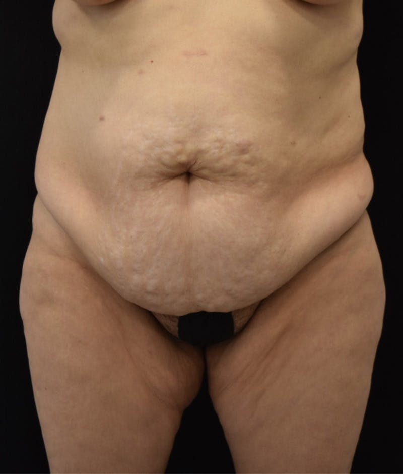 Lower Body Lift Before & After Gallery - Patient 144711509 - Image 1