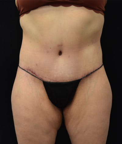 Lower Body Lift Before & After Gallery - Patient 144711509 - Image 2