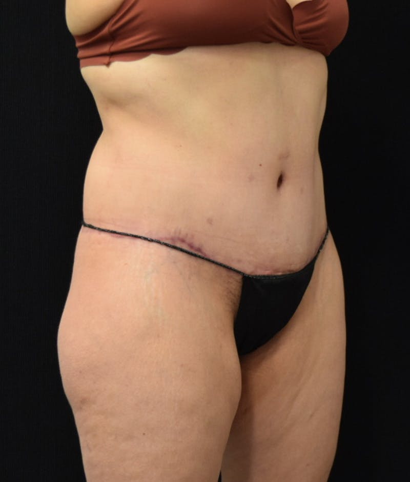 Lower Body Lift Before & After Gallery - Patient 144711509 - Image 4