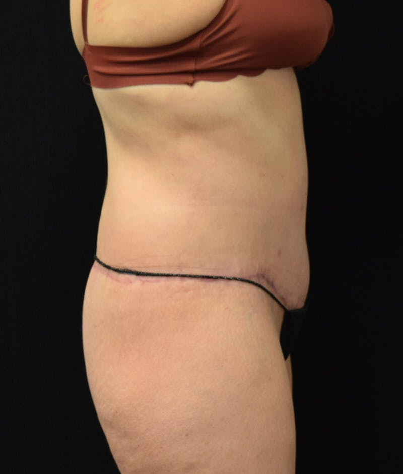 Lower Body Lift Before & After Gallery - Patient 144711509 - Image 6