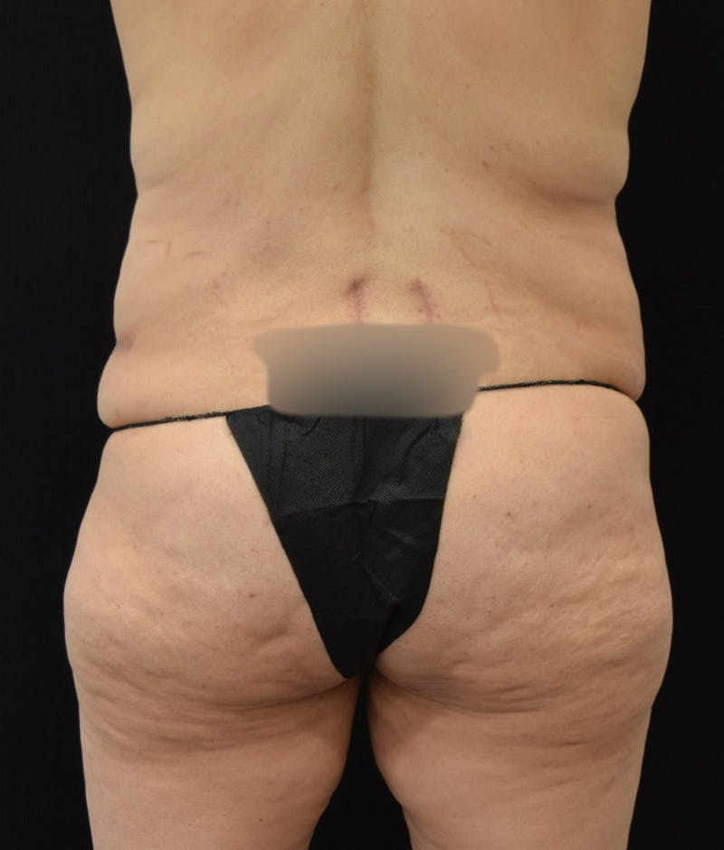 Lower Body Lift Before & After Gallery - Patient 144711509 - Image 7