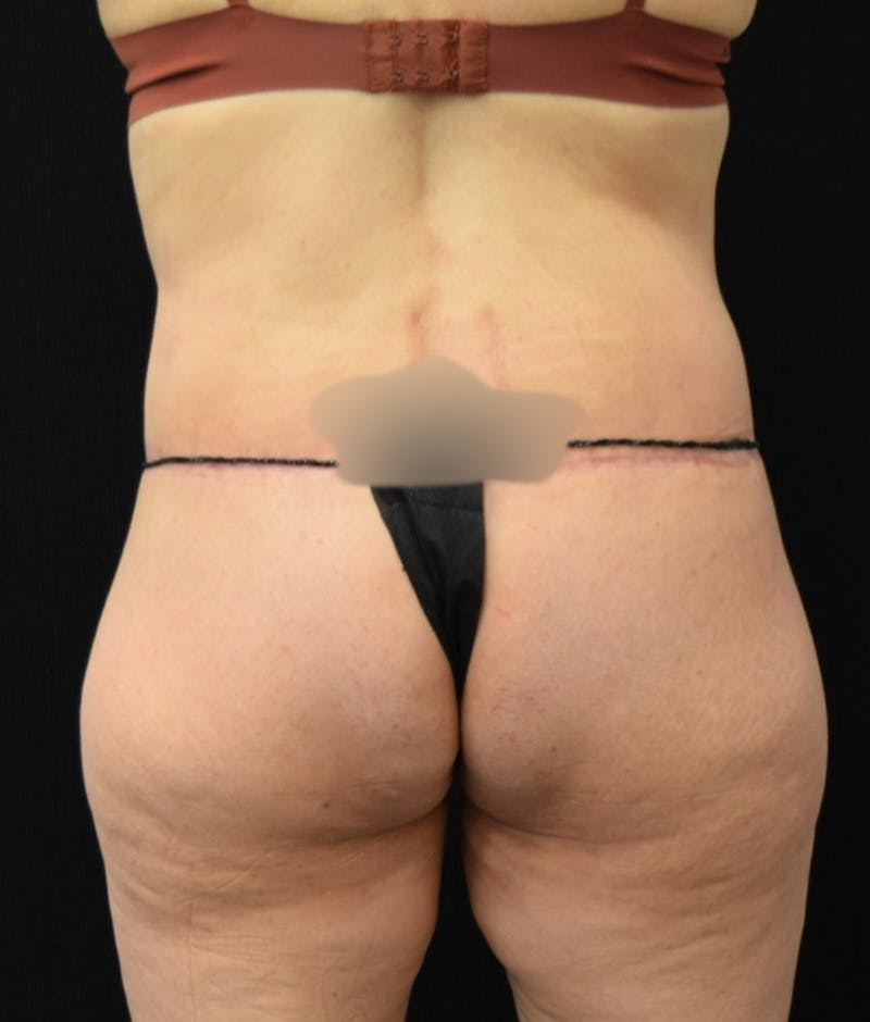 Lower Body Lift Before & After Gallery - Patient 144711509 - Image 8