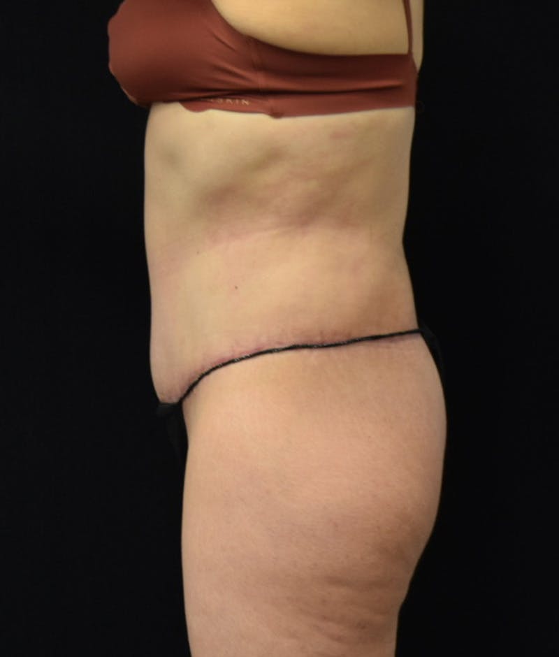 Lower Body Lift Before & After Gallery - Patient 144711509 - Image 12