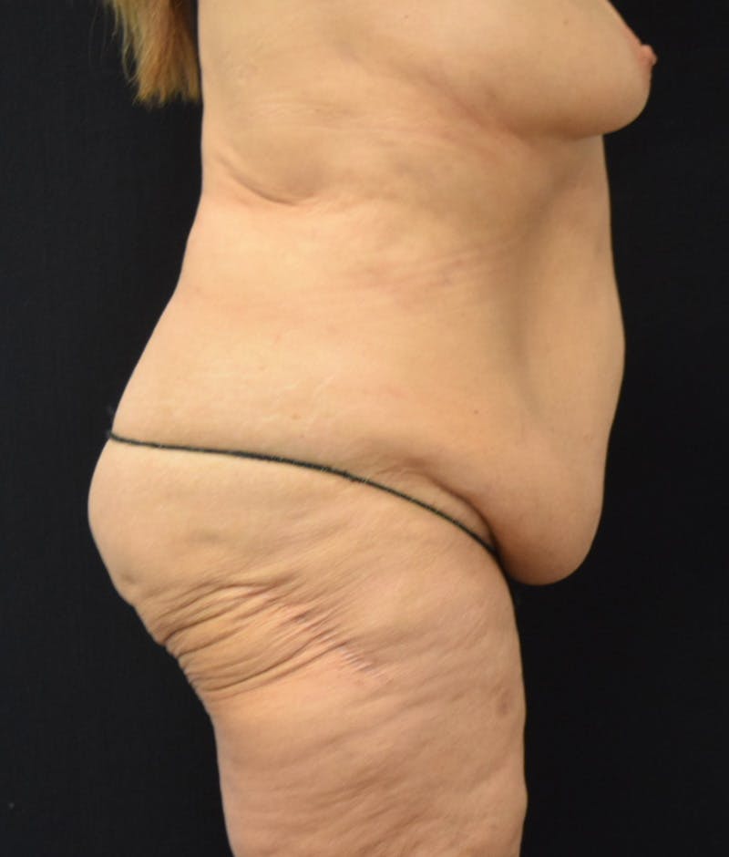 Lower Body Lift Before & After Gallery - Patient 146285675 - Image 5