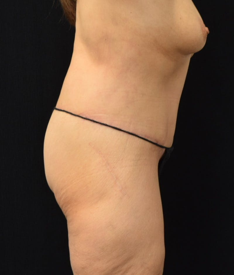 Lower Body Lift Before & After Gallery - Patient 146285675 - Image 6