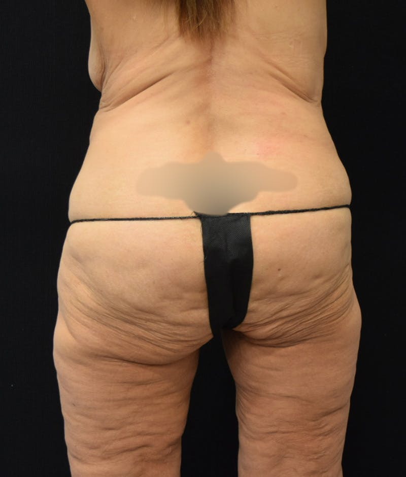 Lower Body Lift Before & After Gallery - Patient 146285675 - Image 7