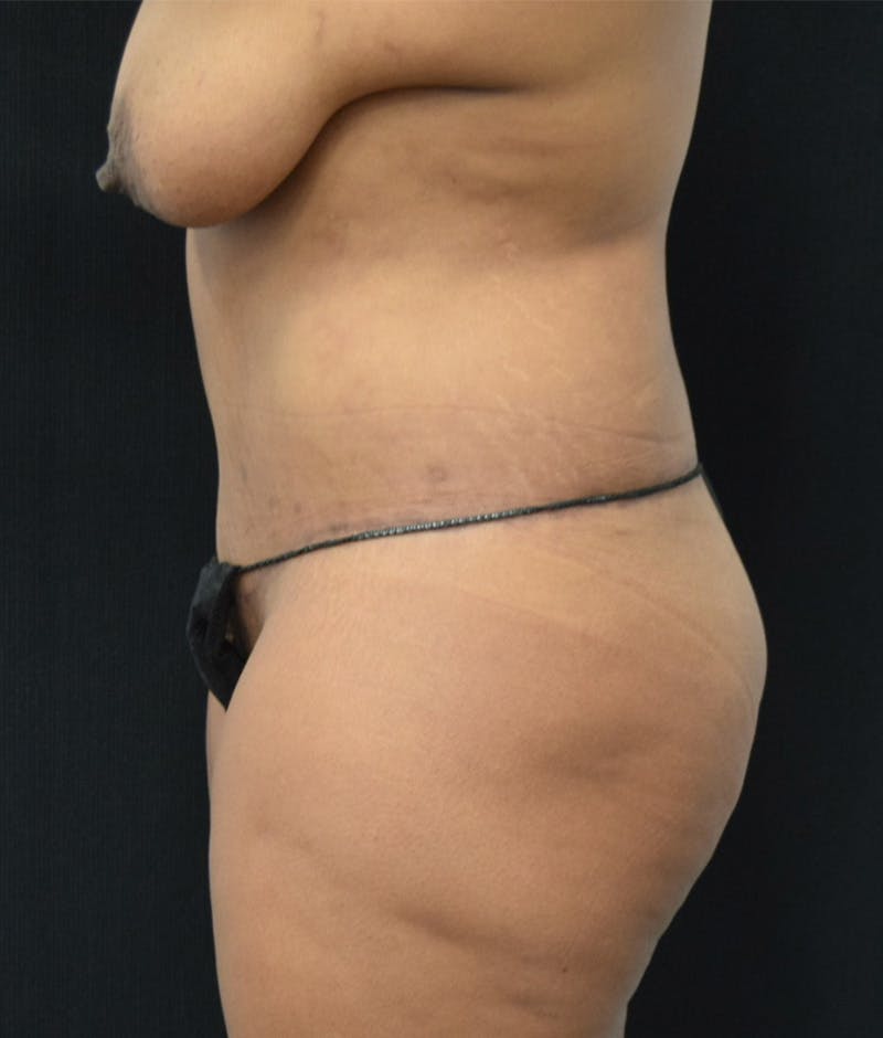 Lower Body Lift Before & After Gallery - Patient 146866205 - Image 10