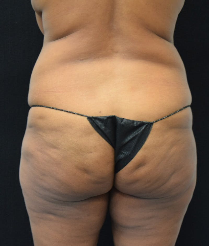 Lower Body Lift Before & After Gallery - Patient 146866205 - Image 11