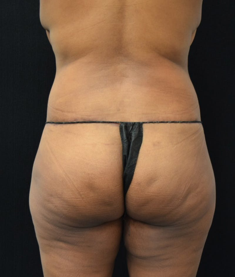 Lower Body Lift Before & After Gallery - Patient 146866205 - Image 12