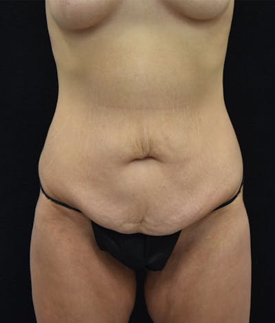 Lower Body Lift Before & After Gallery - Patient 147032865 - Image 1