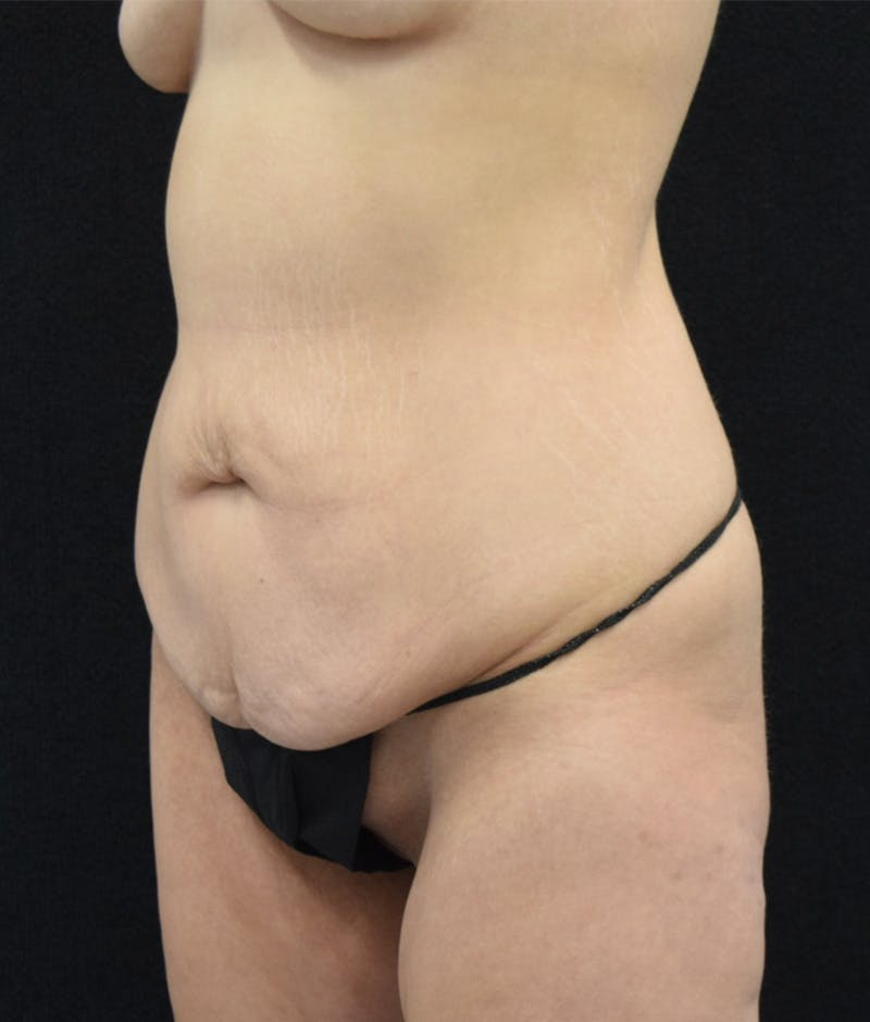 Lower Body Lift Before & After Gallery - Patient 147032865 - Image 7