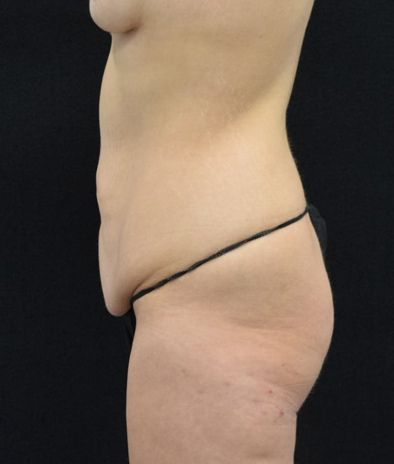 Lower Body Lift Before & After Gallery - Patient 147032865 - Image 9