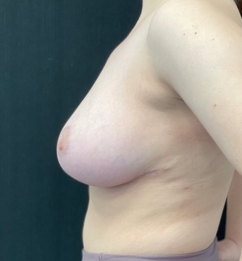 Breast Reduction Before & After Gallery - Patient 147104541 - Image 10